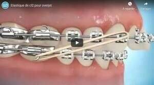 Elastique de cl2 pour overjet