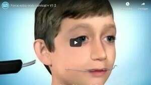 Force extra orale cervical + V1.2