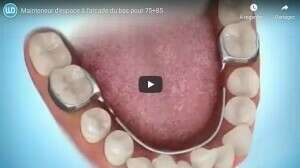 Mainteneur d'espace à l'arcade du bas pour 75+85