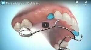 Mainteneur d'espace à l'arcade du haut