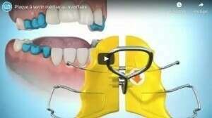 Plaque à verrin médian au maxillaire