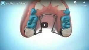 Quad Helix par Dolphin