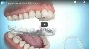 Traitement par gouttières d'alignement