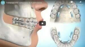 Traitement avec extractions de 4 prémolaires