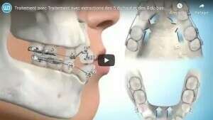 Traitement avec Traitement avec extractions des 5 du haut et des 4 du bas