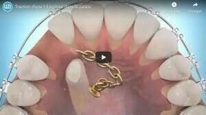 Traction d'une 13 incluse dans le palais