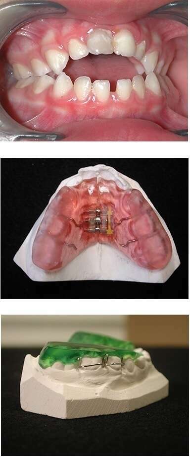 INSTRUCTIONS DE PORT DE LA PLAQUE A VERIN