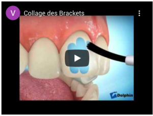 Collage des Brackets