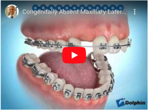 Traitement d’agénésie des incisives latérales par fermeture des espaces