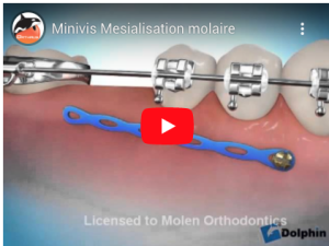 Utilisation de minivis