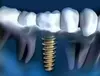 Implants dentaires