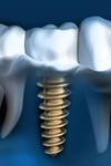 Implant dentaire et sa couronne, vue 3D