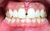 Orthodontie, fermeture d'espaces : avant