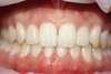 Orthodontie, fermeture d'espaces : après