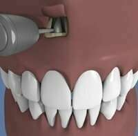 La résection apicale