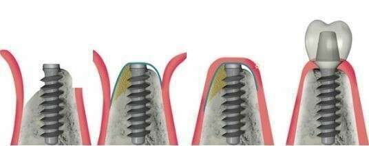 Les comblements osseux