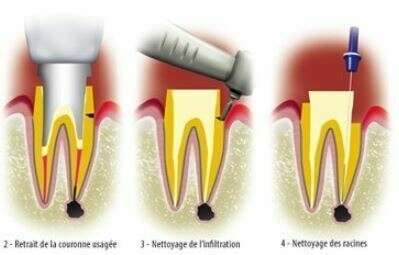 Infiltration et remplacement de couronnes
