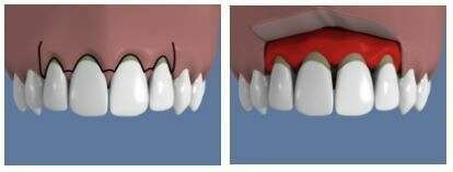 Techniques de chirurgie muco-gingivales avec apport de gencive : la greffe de conjonctif enfoui