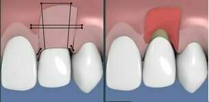 Techniques de chirurgie muco-gingivales avec apport de gencive : la greffe épithélio-conjonctive