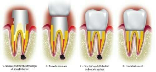 INFILTRATION ET REMPLACEMENT DE COURONNES