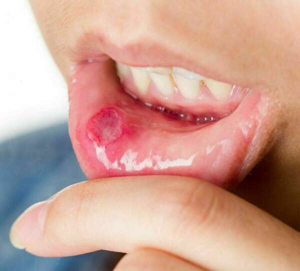 Comment le microbiote oral affecte votre santé globale