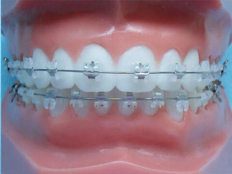 LES APPAREILS ORTHODONTIQUES AUTO-LIGATURANT