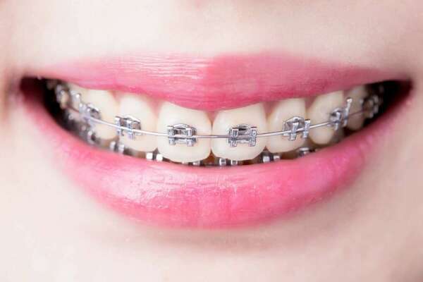 LES PREMIERS JOURS AVEC UN APPAREIL ORTHODONTIQUE