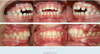 Orthodontie précoce en denture mixte