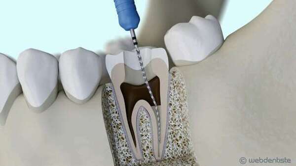 Protocole de dévitalisation d'une dent ou traitement endodontique