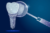 Implant dentaire et sa couronne, vue 3D, implantologie à Saint-Lô
