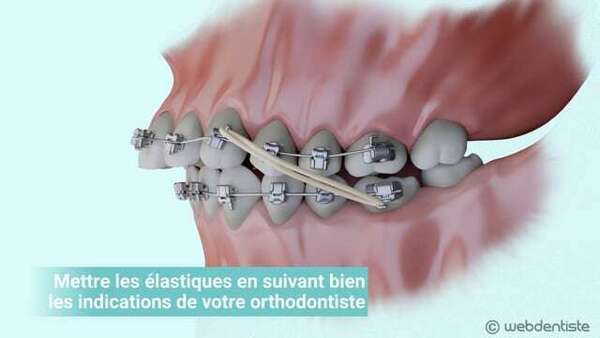 Les élastiques de classes ii et iii
