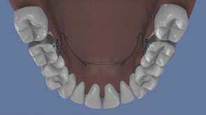 Le quad helix : traitement du palais et de l’alignement des dents