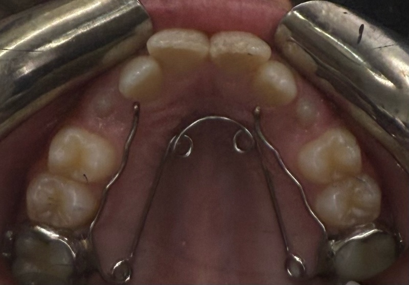 quad helix, cabinet du Boutonnet