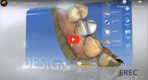 CEREC Crown Demo