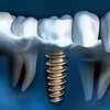 Image d'implant