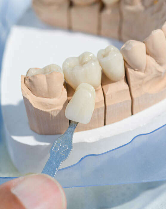 PROTHÈSE DENTAIRE SUR IMPLANT