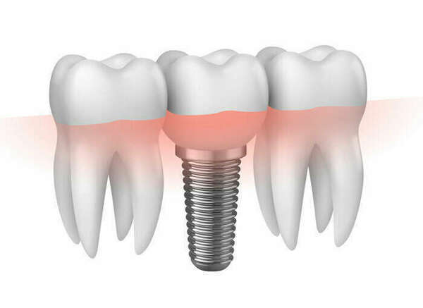 PROTHÈSE SUR IMPLANT