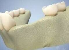 LA GREFFE OSSEUSE D'APPOSITION OU GREFFE EN ONLAY