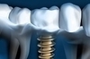 Image d'implant