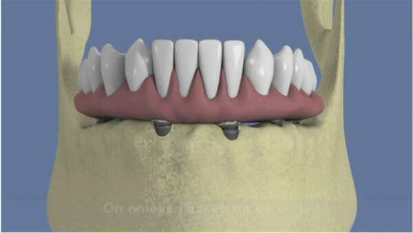 Mandibule complète et traitement implantaire pour un bridge fixe vissé