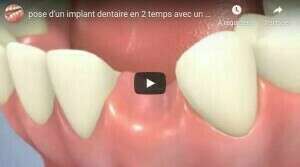 pose d'un implant dentaire en 2 temps avec un pilier titane