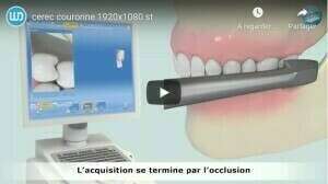 Cerec couronne