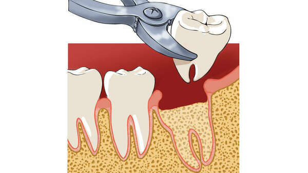 EXTRACTION DE DENT TEMPORAIRE ET SUIVI ORTHODONTIQUE