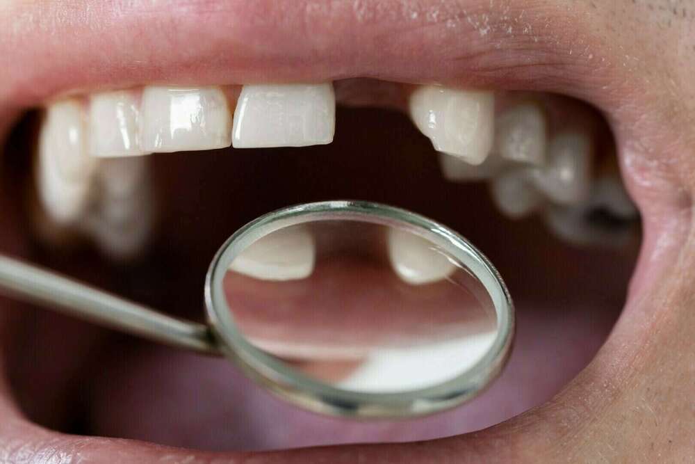 Pourquoi faut-il remplacer une dent manquante ?