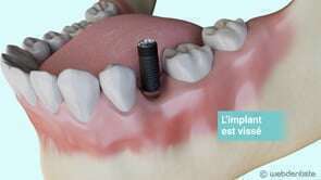 Pose d'un implant simple