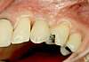 Implant de canine