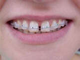 L'orthodontie invisible