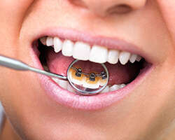 L'ORTHODONTIE INVISIBLE