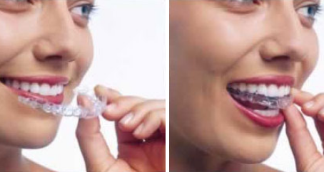 LA TECHNIQUE INVISALIGN® – ALIGN TECHNOLOGY