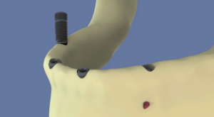 Mandibule : All on four